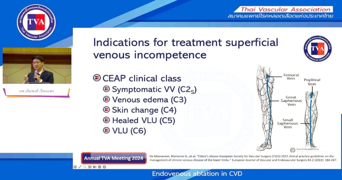 0703 – Endovenous ablation in CVD