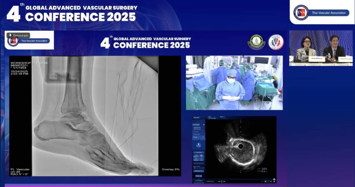 090312 – Live case transmission 3: Vajira Hospital (Complex BTK lesion) #2