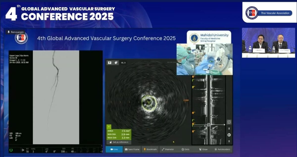 090313 – Live case transmission 3: Vajira Hospital (Complex BTK lesion) #3